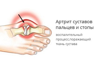 псориатический артрит