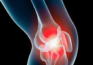 гонартроз коленного сустава лечение