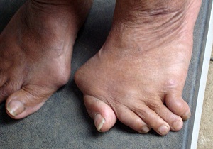 лечение артроза стопы ног