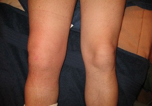 воспаление коленного сустава лечение