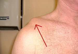 разрыв связок плечевого сустава