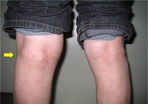 киста бейкера коленного сустава лечение отзывы