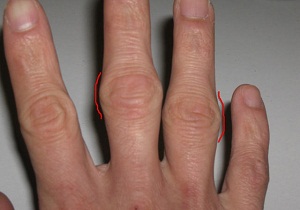артроз суставов пальцев рук лечение