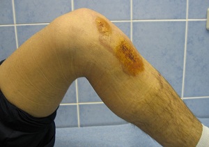 разрыв связок коленного сустава лечение