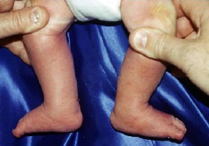 дисплазия тазобедренных суставов у младенцев
