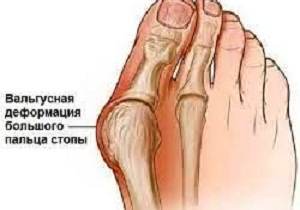 лечение вальгусной деформации большого пальца стопы