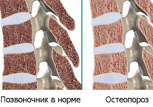 остеопороз костей