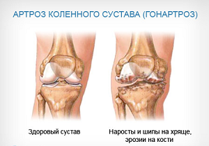 артроз коленного сустава симптомы и лечение
