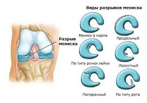 разрыв мениска коленного сустава