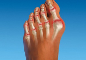 воспаление сустава большого пальца ноги лечение
