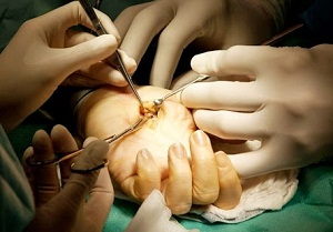 контрактура дюпюитрена лечение после операции отзывы