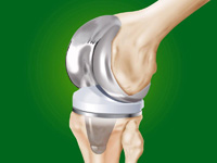 эндопротезирование коленного сустава