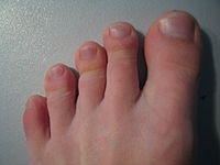 воспаление суставов больших пальцев ног