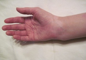 перелом лучевой кости руки лечение срок срастания