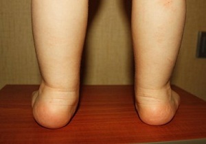 ортопедическая обувь для детей при вальгусной деформации