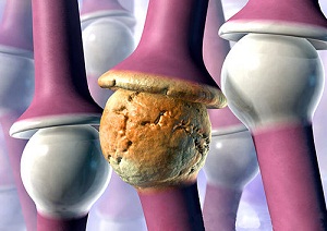 ревматоидный артрит фото
