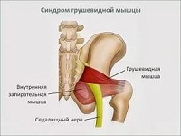 синдром грушевидной мышцы