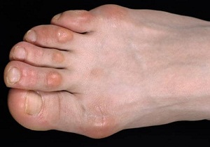 шишка на пальце ноги