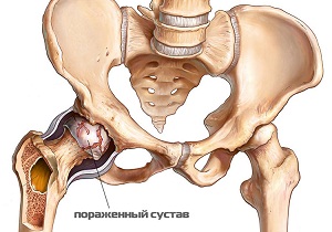 Что такое артрит тазобедренного сустава как вылечить thumbnail