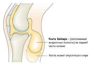 Изображение - Киста бейкера коленного сустава лечение в домашних 1-14