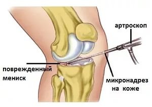 Изображение - Как вылечить мениск коленного сустава 1-17