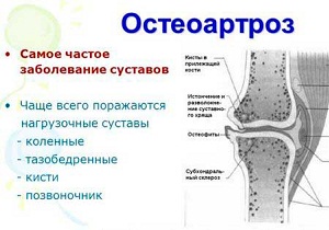Лечение остеоартроза тазобедренного сустава 2 степени лечение thumbnail