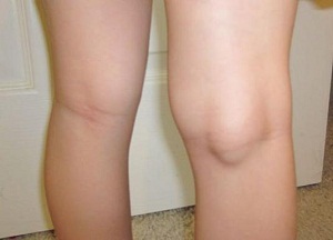 Изображение - Киста бейкера коленного сустава лечение в домашних 1.-Kista-Beykera-lechenie