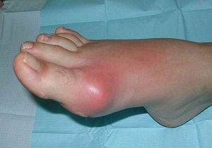 Как выглядит артрит на ногах фото thumbnail
