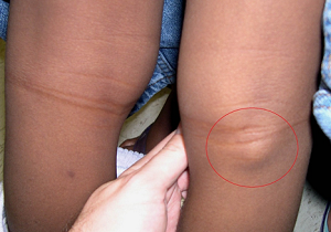 Изображение - Киста бейкера коленного сустава лечение в домашних 4-1