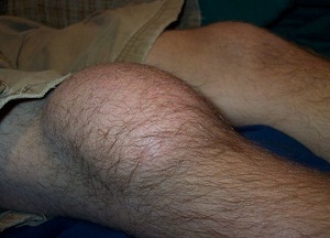 методы лечения бурсита коленного сустава