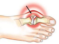 Изображение - Что делать при коленного сустава artrit-stopy