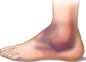 правила лечения вывиха ноги в районе щиколотки
