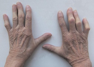 методы лечения артроза пальцев рук
