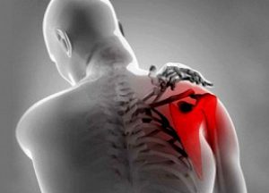 как лечить тендинит плечевого сустава