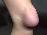 Что такое артрит тазобедренного сустава и как его лечить thumbnail