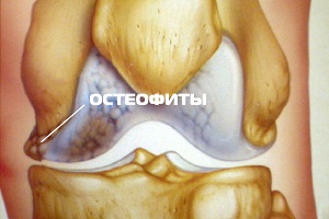 Изображение - Остеофиты коленного сустава лечение 1-104