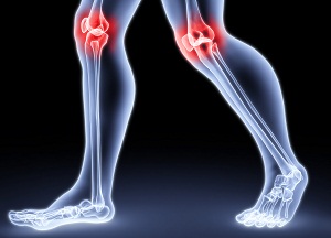 как лечить артроз колена в домашних условиях