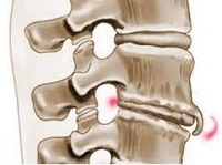 Изображение - Как снять боль в коленном суставе osteofity-1