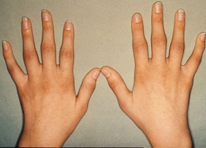 как лечить воспаление суставов пальцев рук