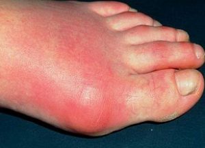 как лечить воспаление суставов больших пальцев ног