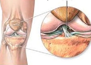 методы лечения лигаментоза коленного сустава